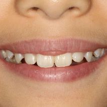 Patient smile after braces