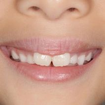 Patient smile before braces