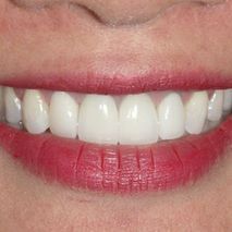 Patient smile after veneers