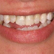Patient smile before veneers