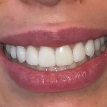 Patient smile after professional whitening
