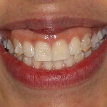 Patient smile before professional whitening